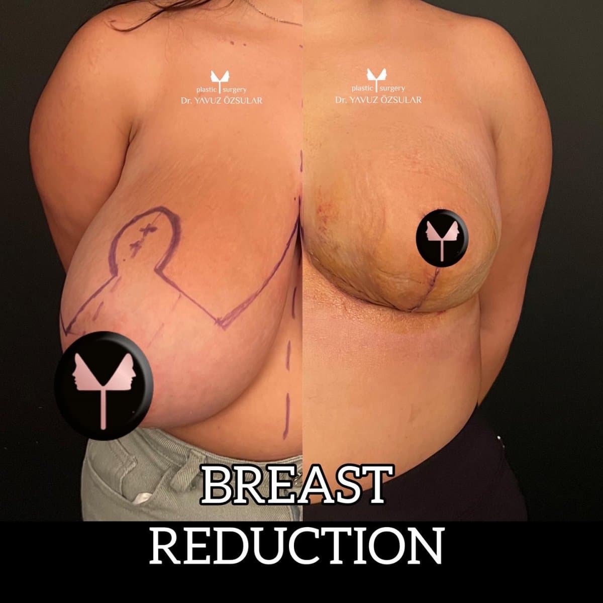 breast reduction