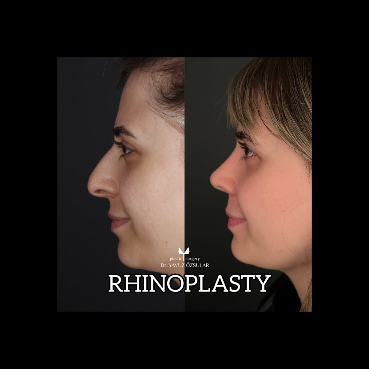 rhinoplasty