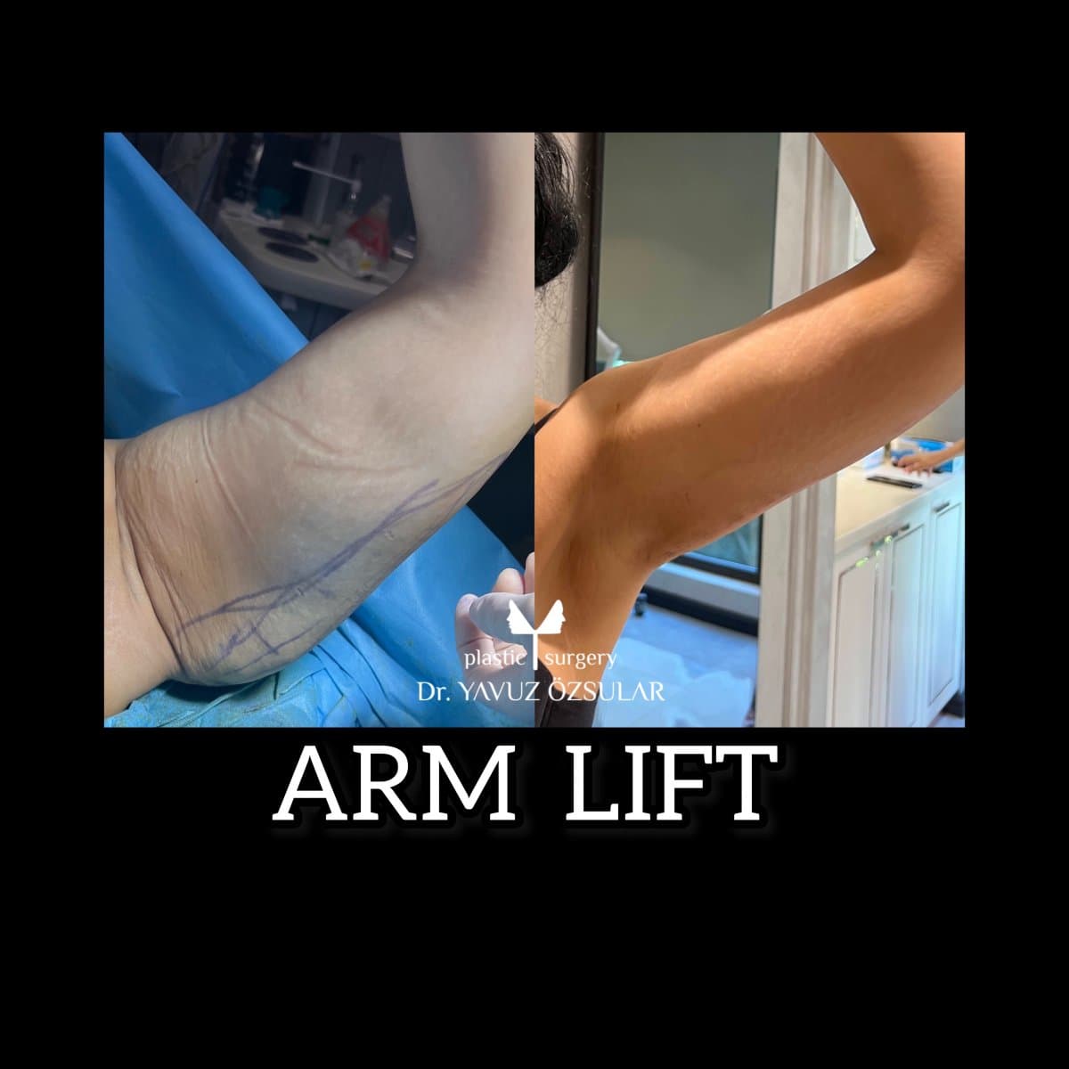 arm lift
