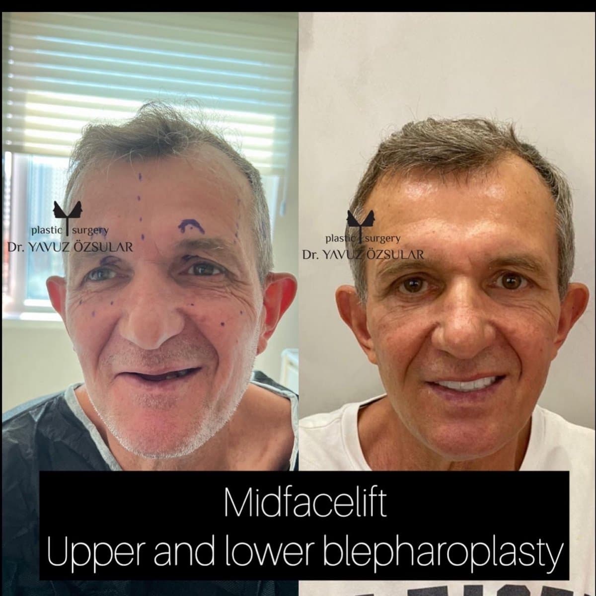 midface lift and blepharoplasty
