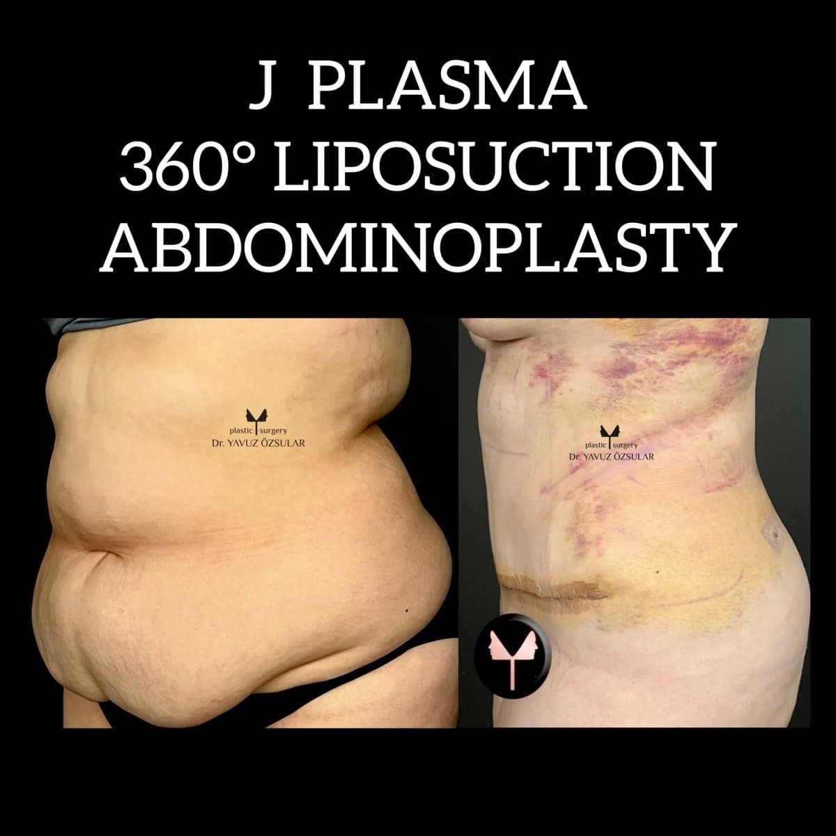 tummy tuck and 360 liposuction