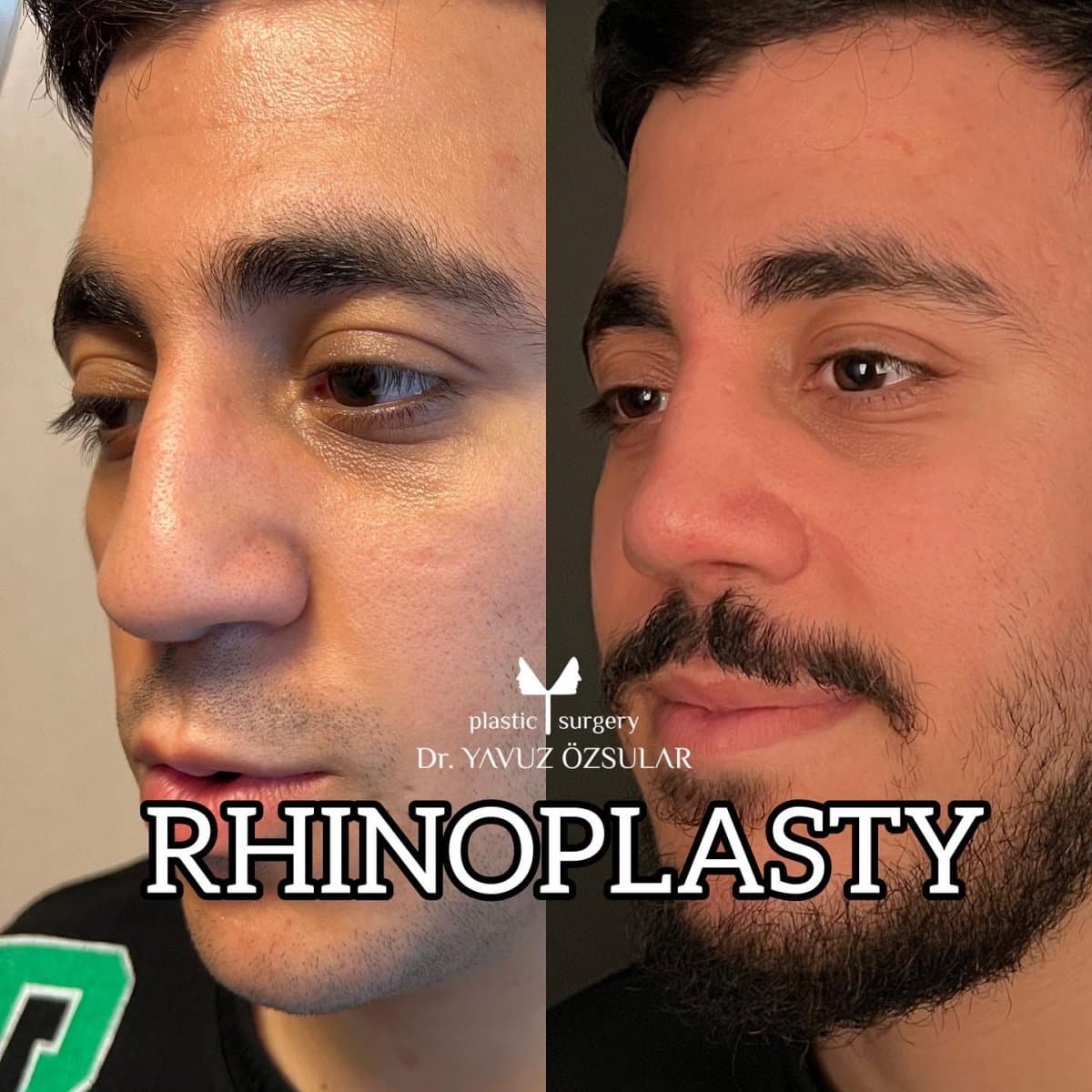 rhinoplasty