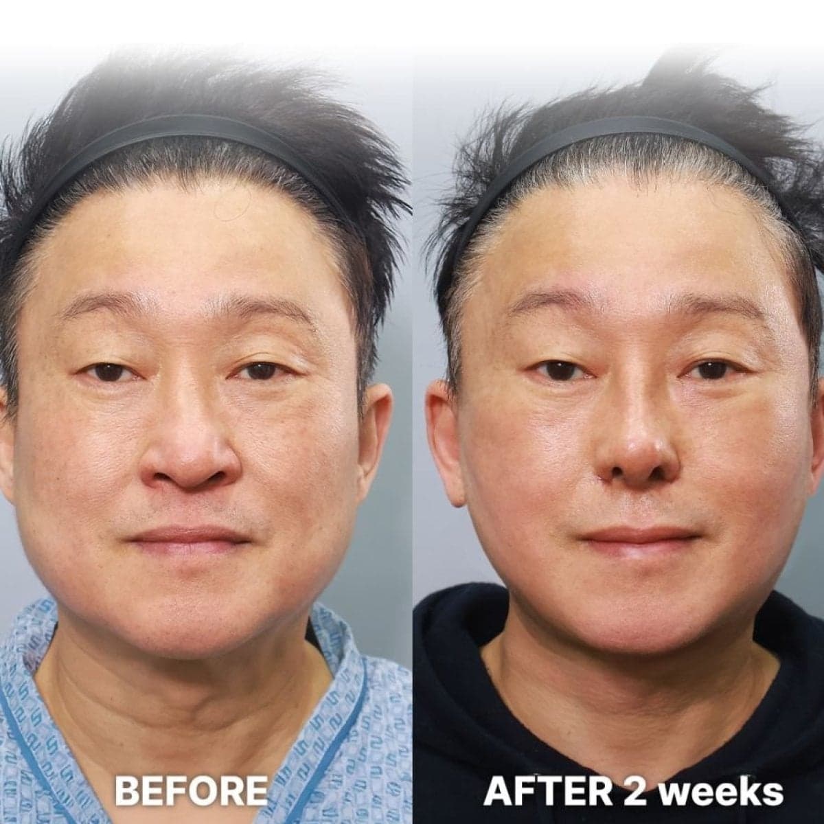 endoscopic facelift