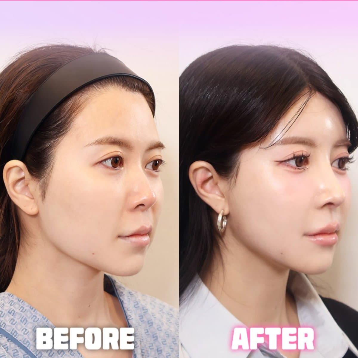 rhinoplasty