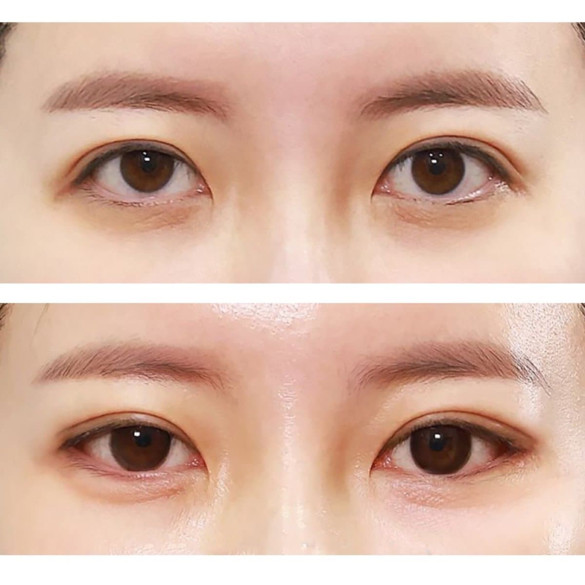 blepharoplasty