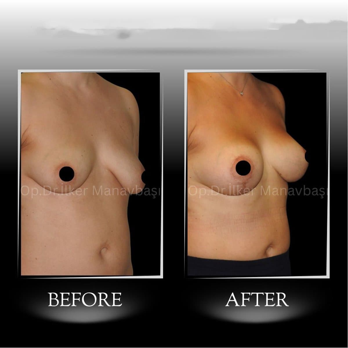 breast implants with lift