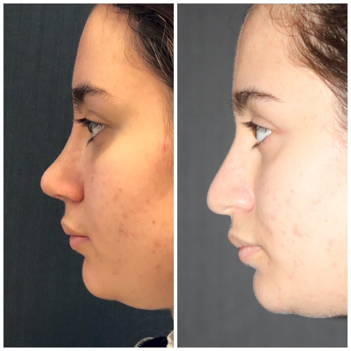 rhinoplasty