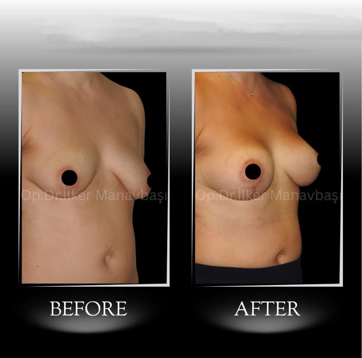 breast augmentation