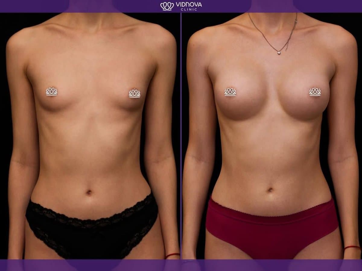 mammoplasty