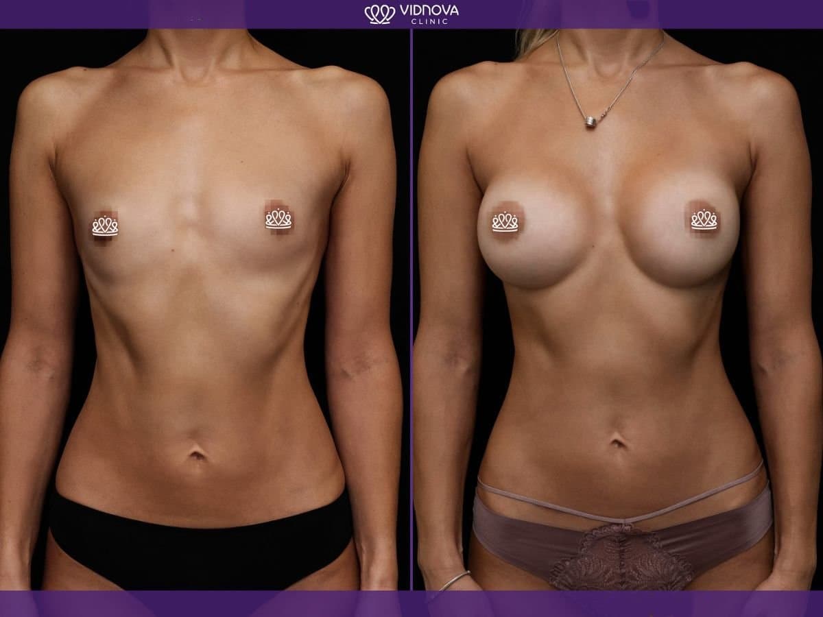 mammoplasty