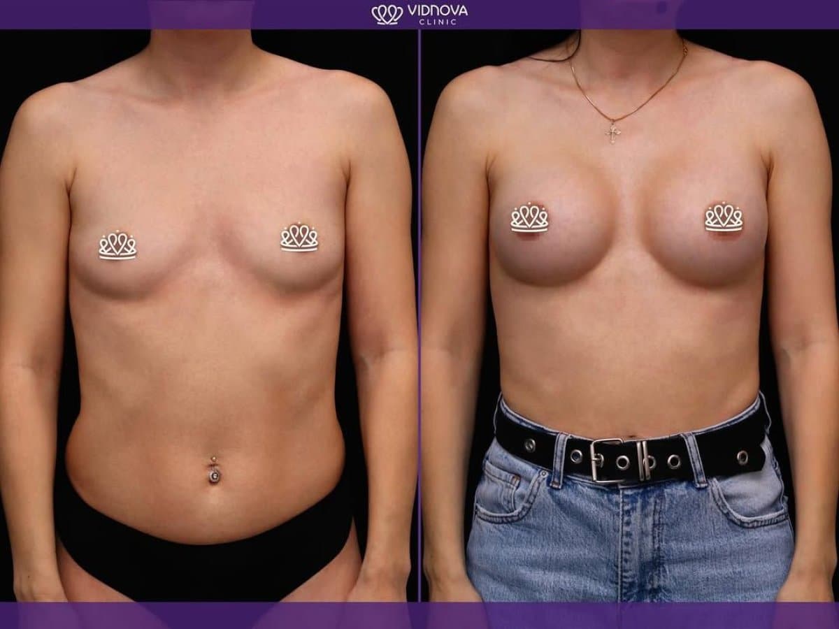 mammoplasty