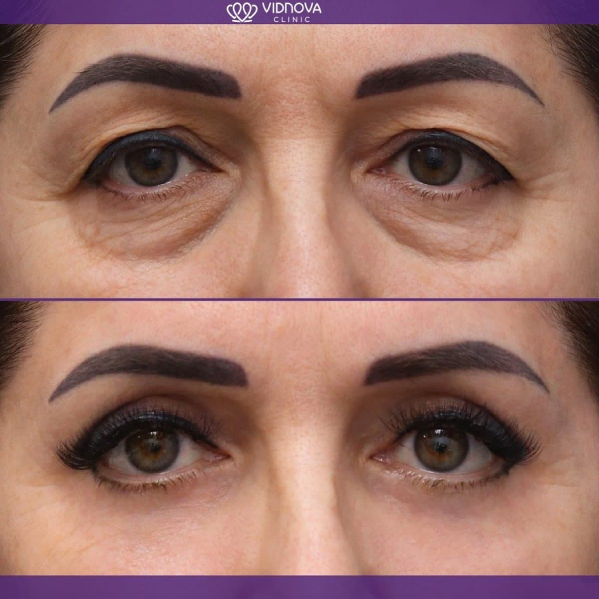 blepharoplasty
