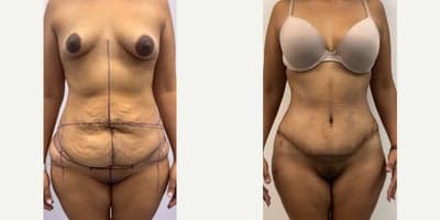 Case 2991 - 25-34 year old gender nonconforming person treated with Tummy Tuck, Liposuction