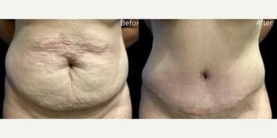 Case 3 - Woman treated with Tummy Tuck