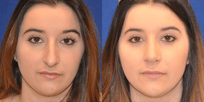Case 3195 - Woman treated with Rhinoplasty