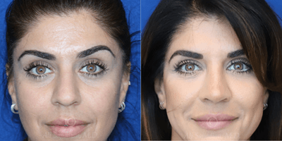Case 3196 - Woman treated with Rhinoplasty