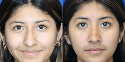 Case 3197 - Woman treated with Rhinoplasty