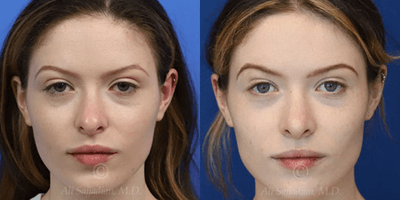 Case 3198 - Woman treated with Rhinoplasty