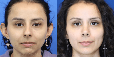 Case 3205 - Woman treated with Rhinoplasty