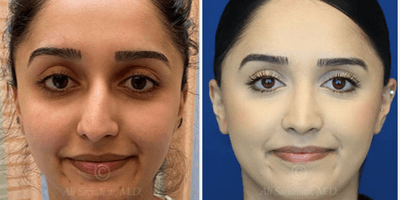 Case 3206 - Woman treated with Rhinoplasty