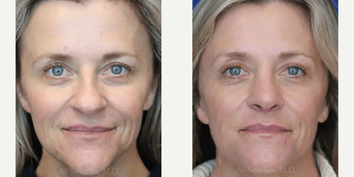 Case 3207 - Woman treated with Rhinoplasty