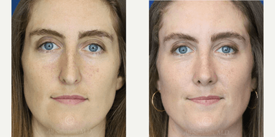 Case 3208 - Woman treated with Rhinoplasty