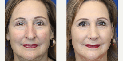 Case 3209 - Woman treated with Rhinoplasty