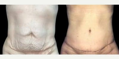 Case 4 - Woman treated with Tummy Tuck