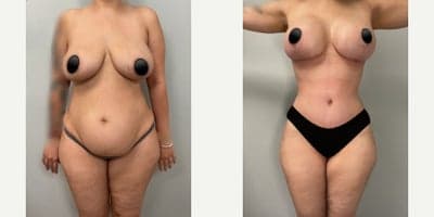 Woman treated with Tummy Tuck