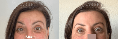 45-54 year old woman treated with Botox