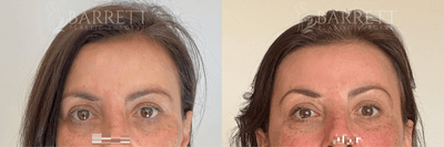 45-54 year old woman treated with Botox