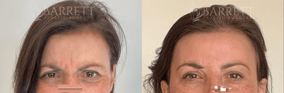 45-54 year old woman treated with Botox