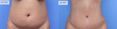 Case 6 - Woman treated with Tummy Tuck, Liposuction