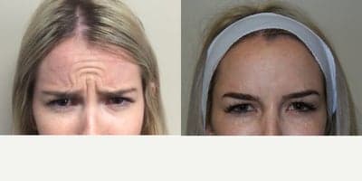 25 year old woman treated with Botox