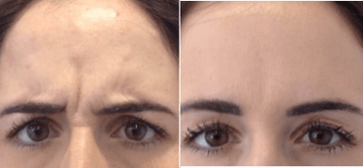 25-34 year old woman treated with Botox