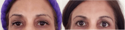 45-54 year old woman treated with Botox