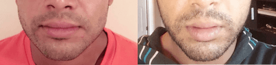 25-34 year old man treated with Botox