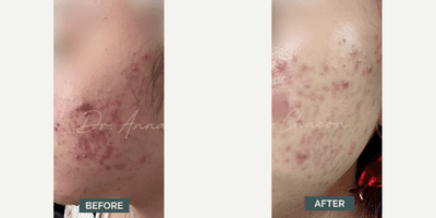 Case 6826 - Woman treated with Accutane