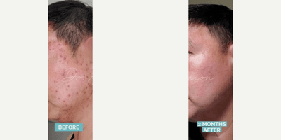 Case 6827 - Man treated with Accutane