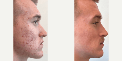 Case 6828 - 21 year old man treated with Accutane