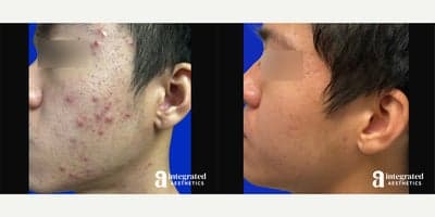 Case 6829 - 18-24 year old man treated with Accutane