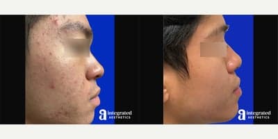 Case 6830 - 18-24 year old man treated with Accutane