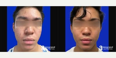 Case 6831 - 18-24 year old man treated with Accutane