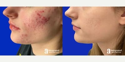 Case 6832 - 18-24 year old woman treated with Accutane
