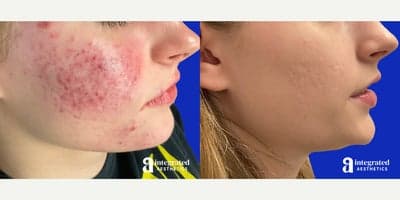 Case 6833 - 18-24 year old woman treated with Accutane