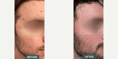 Case 6834 - Man treated with Accutane