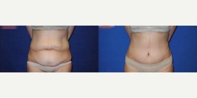 Case 7 - Woman treated with Tummy Tuck