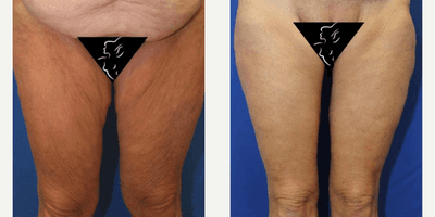 Case 7029 - 45-54 year old woman treated with Thigh Lift