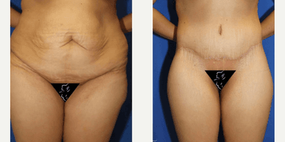 Case 7030 - 25-34 year old woman treated with Thigh Lift