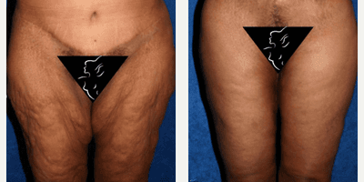 Case 7031 - 55-64 year old woman treated with Thigh Lift